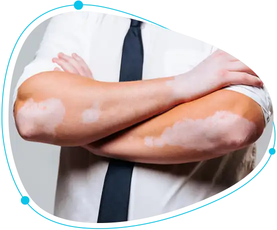 Top hospitals for vitiligo surgery