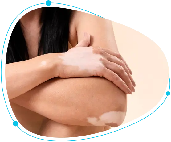 Vitiligo surgery health check