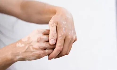 Vitiligo Surgery Treatment