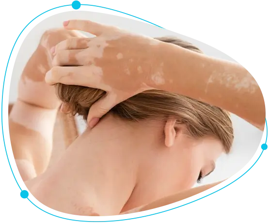 Vitiligo surgical treatment in Bangladesh