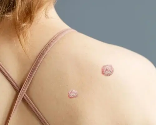 Warts
