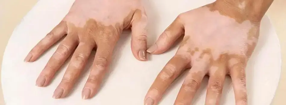 শ্বেতী রোগ থেকে মুক্তির উপায়