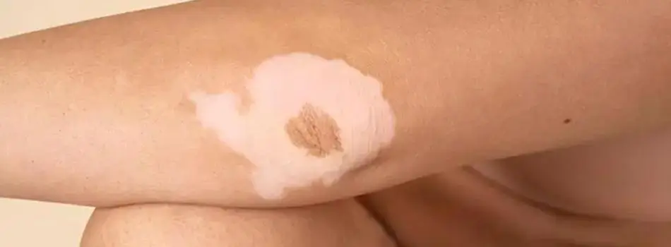 শ্বেতী রোগ কেন হয়